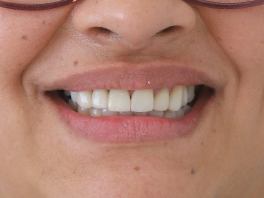 Imagem final, caso de reabilitação estética