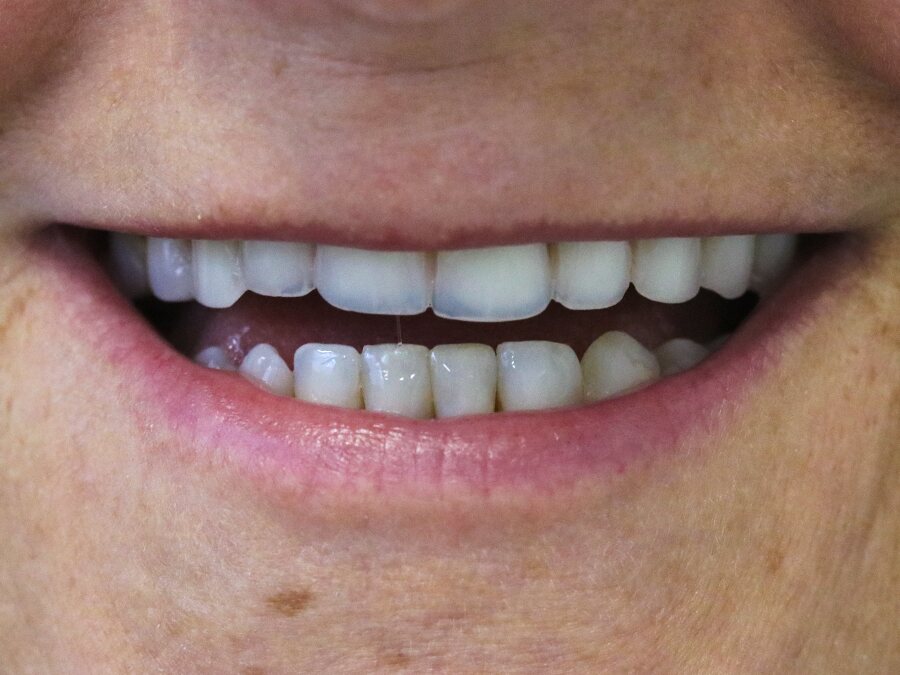Imagem final, caso de harmonização do sorriso